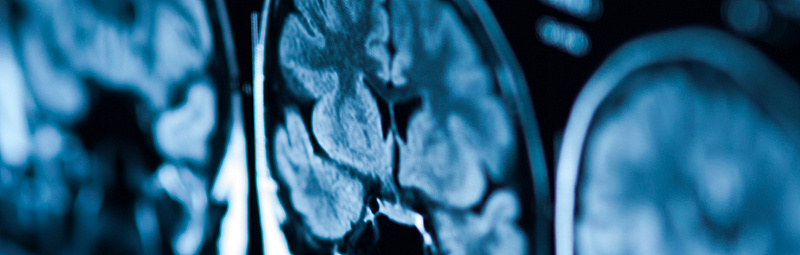 Tomographiebild eines Gehirns Tomography pictures of the brain